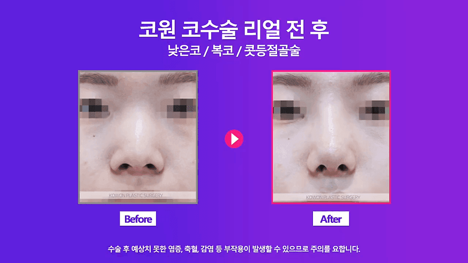 여자 낮은코 교정 사례 — 정면에서만 낮아 보이는 코, 비중격 연장과 절골술로 확인한 것 관련 이미지 6/8