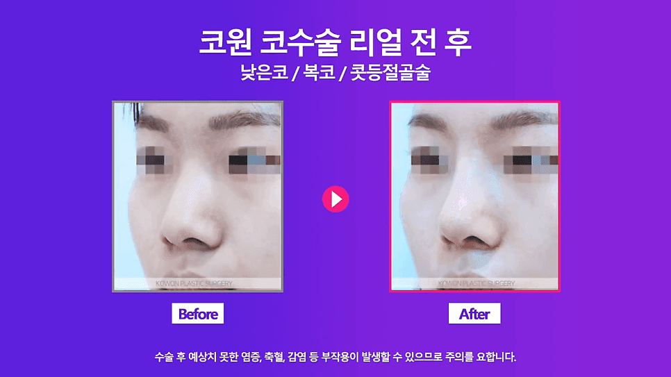 여자 낮은코 교정 사례 — 정면에서만 낮아 보이는 코, 비중격 연장과 절골술로 확인한 것 관련 이미지 7/8