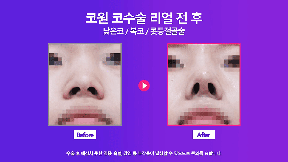 여자 낮은코 교정 사례 — 정면에서만 낮아 보이는 코, 비중격 연장과 절골술로 확인한 것 관련 이미지 8/8