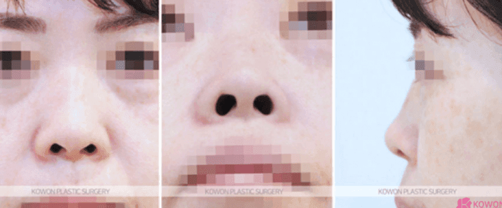 처음 코성형을 고민할 때 묻는 것들 — 실리콘 교체 주기·마취·코살·부작용까지 관련 이미지 4/10