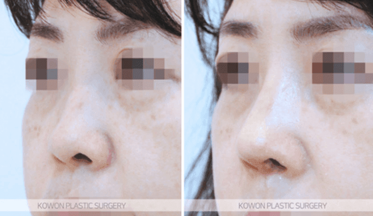 처음 코성형을 고민할 때 묻는 것들 — 실리콘 교체 주기·마취·코살·부작용까지 관련 이미지 6/10