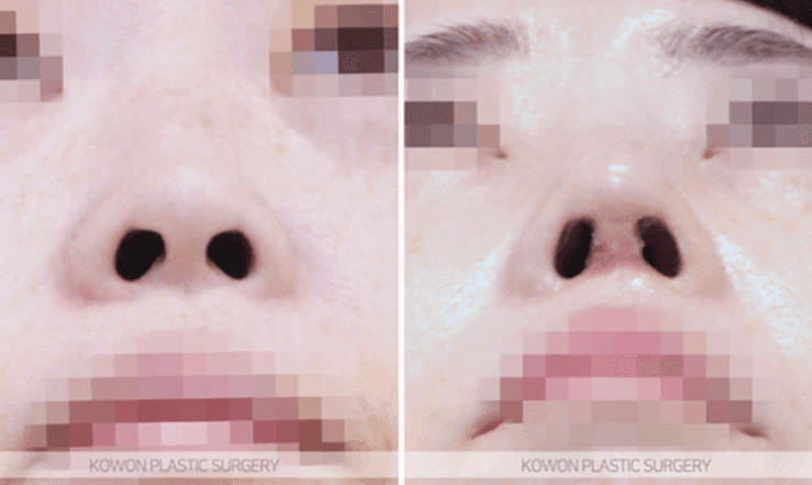 처음 코성형을 고민할 때 묻는 것들 — 실리콘 교체 주기·마취·코살·부작용까지 관련 이미지 7/10