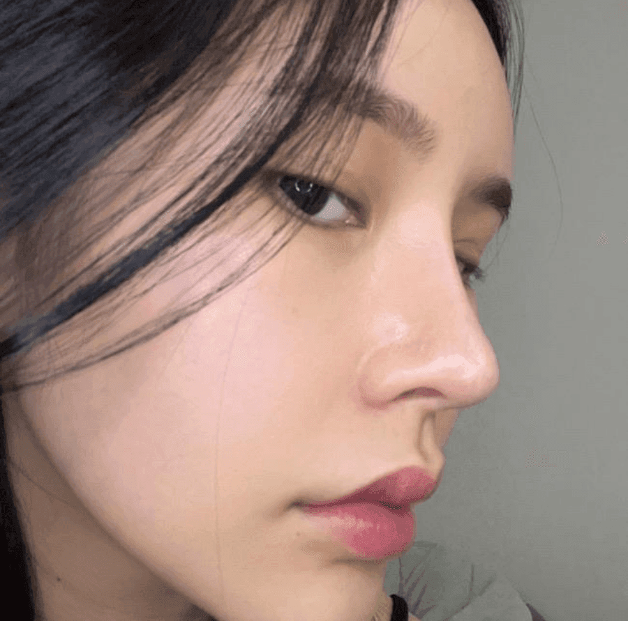 너무 높고 화려한 코, 자연스럽게 낮추는 재수술 — 귀연골·비중격 교정 관련 이미지 1/29