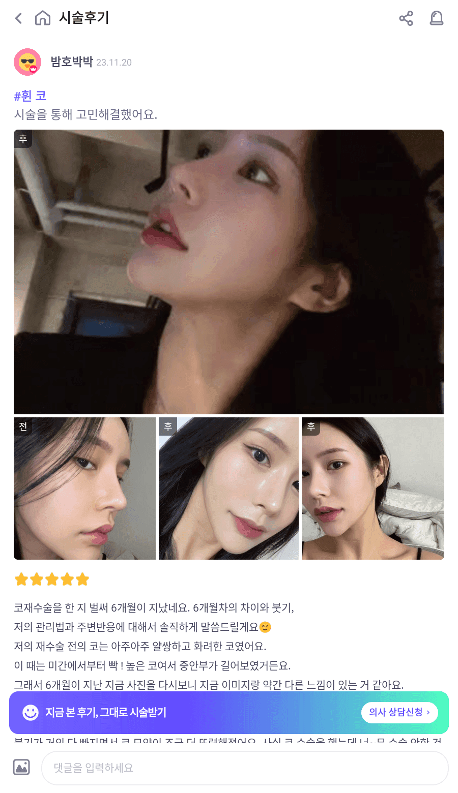 너무 높고 화려한 코, 자연스럽게 낮추는 재수술 — 귀연골·비중격 교정 관련 이미지 5/29