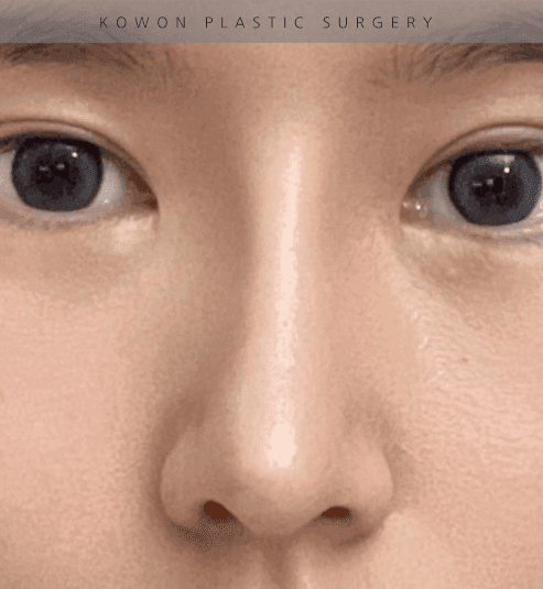 너무 높고 화려한 코, 자연스럽게 낮추는 재수술 — 귀연골·비중격 교정 관련 이미지 6/29