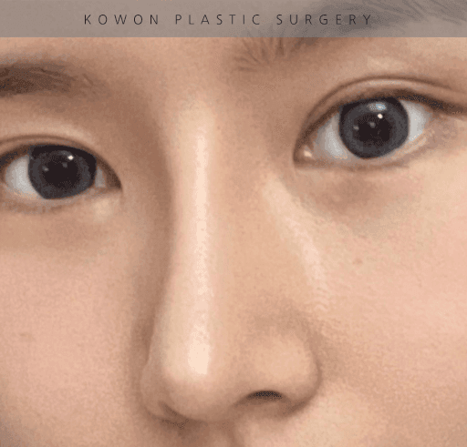 너무 높고 화려한 코, 자연스럽게 낮추는 재수술 — 귀연골·비중격 교정 관련 이미지 8/29