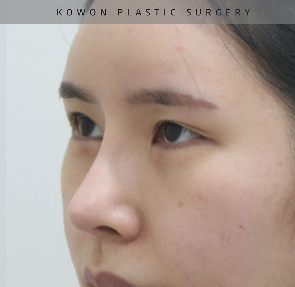 너무 높고 화려한 코, 자연스럽게 낮추는 재수술 — 귀연골·비중격 교정 관련 이미지 9/29