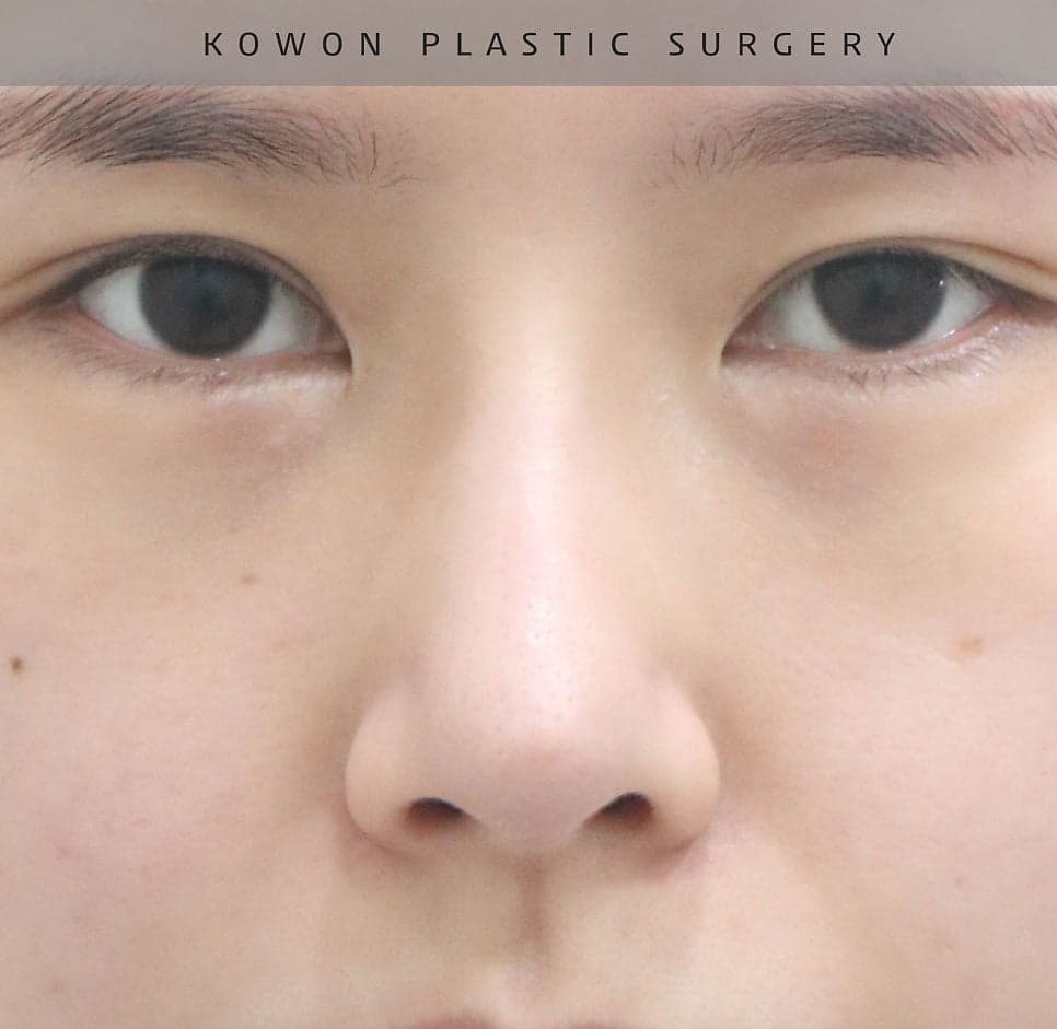 너무 높고 화려한 코, 자연스럽게 낮추는 재수술 — 귀연골·비중격 교정 관련 이미지 11/29