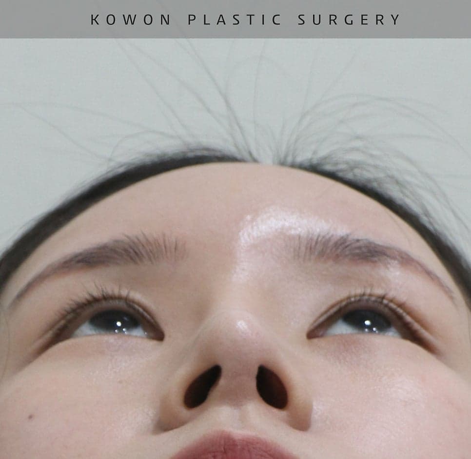 너무 높고 화려한 코, 자연스럽게 낮추는 재수술 — 귀연골·비중격 교정 관련 이미지 17/29