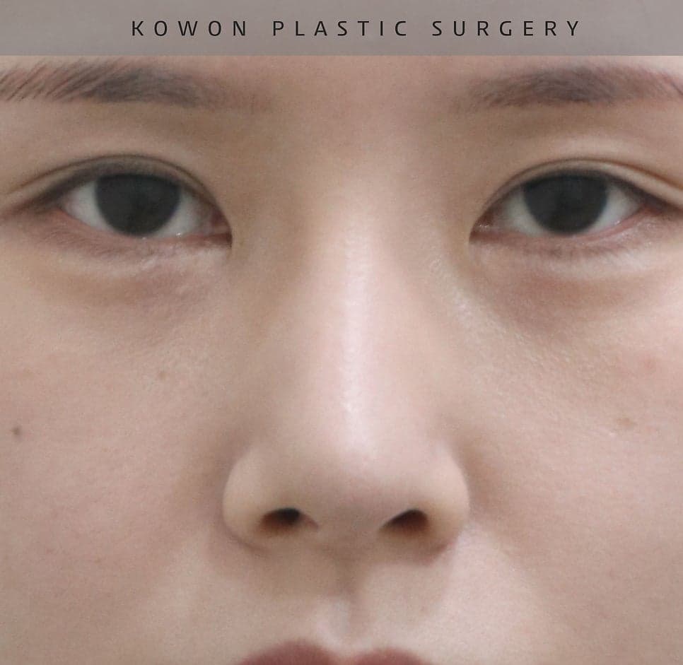 너무 높고 화려한 코, 자연스럽게 낮추는 재수술 — 귀연골·비중격 교정 관련 이미지 18/29