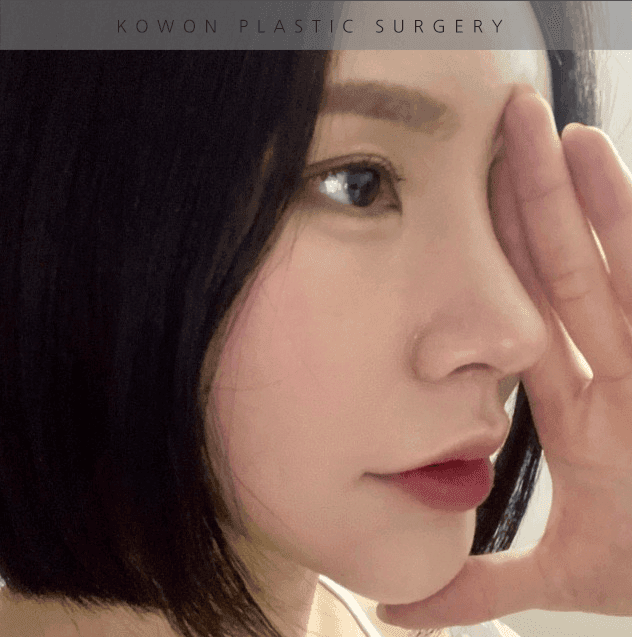 너무 높고 화려한 코, 자연스럽게 낮추는 재수술 — 귀연골·비중격 교정 관련 이미지 20/29