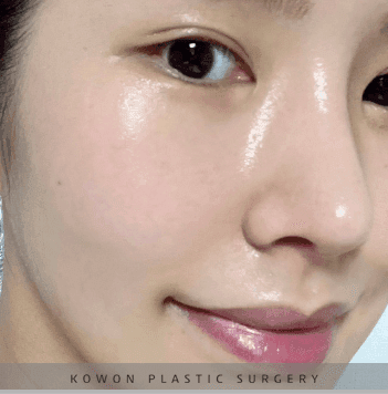 너무 높고 화려한 코, 자연스럽게 낮추는 재수술 — 귀연골·비중격 교정 관련 이미지 21/29