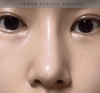 너무 높고 화려한 코, 자연스럽게 낮추는 재수술 — 귀연골·비중격 교정 관련 이미지 23/29