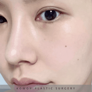 너무 높고 화려한 코, 자연스럽게 낮추는 재수술 — 귀연골·비중격 교정 관련 이미지 25/29