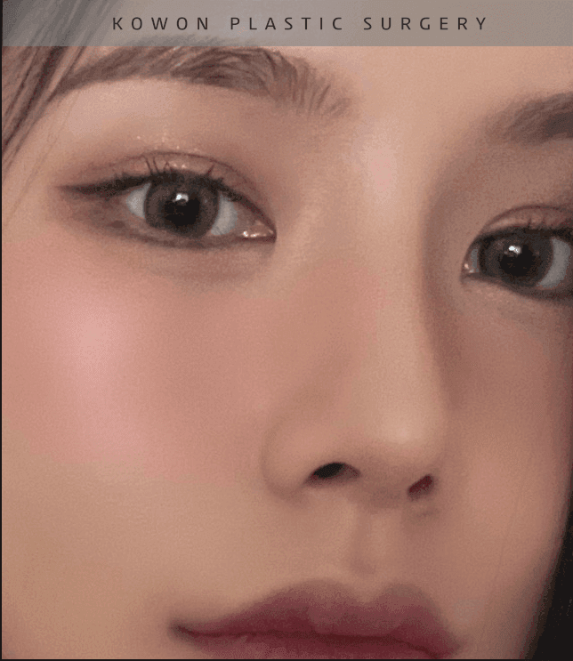 너무 높고 화려한 코, 자연스럽게 낮추는 재수술 — 귀연골·비중격 교정 관련 이미지 26/29