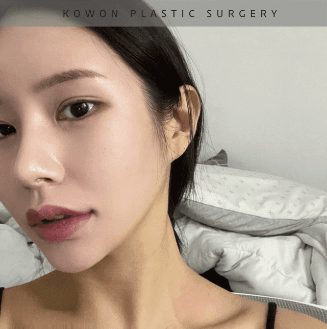 너무 높고 화려한 코, 자연스럽게 낮추는 재수술 — 귀연골·비중격 교정 관련 이미지 28/29
