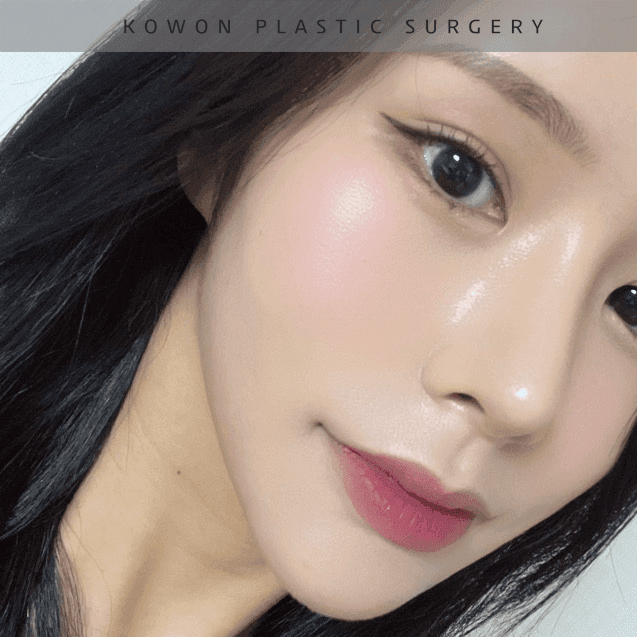 너무 높고 화려한 코, 자연스럽게 낮추는 재수술 — 귀연골·비중격 교정 관련 이미지 29/29