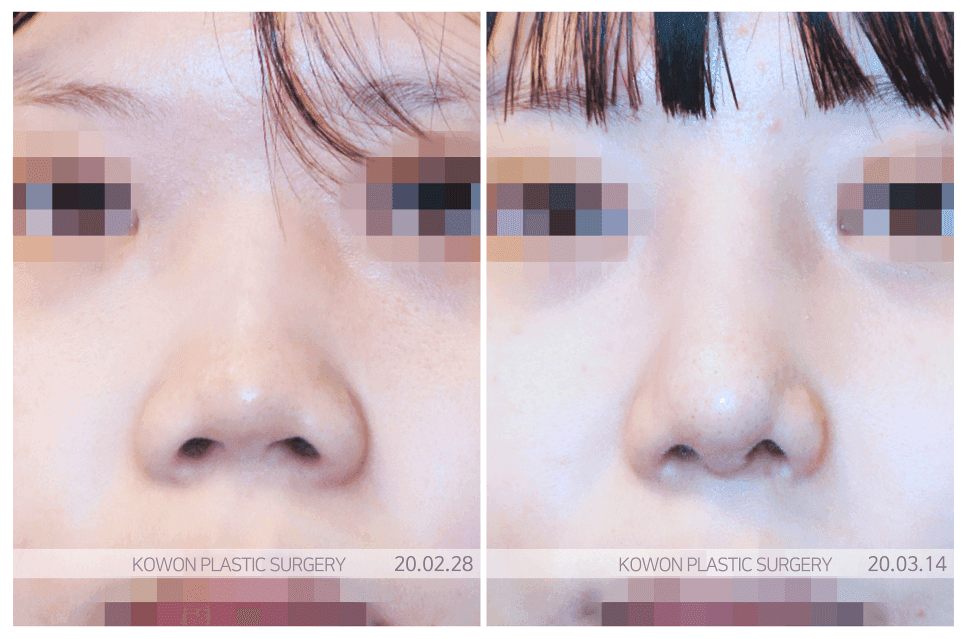 Image 1/4 for: flat nose — does inserting an implant alone solve it? Correction criteria seen through harmony and stability