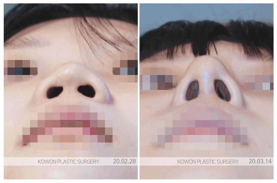 납작코, 보형물만 넣으면 해결될까 — 조화·안정성으로 보는 교정 기준 관련 이미지 2/4