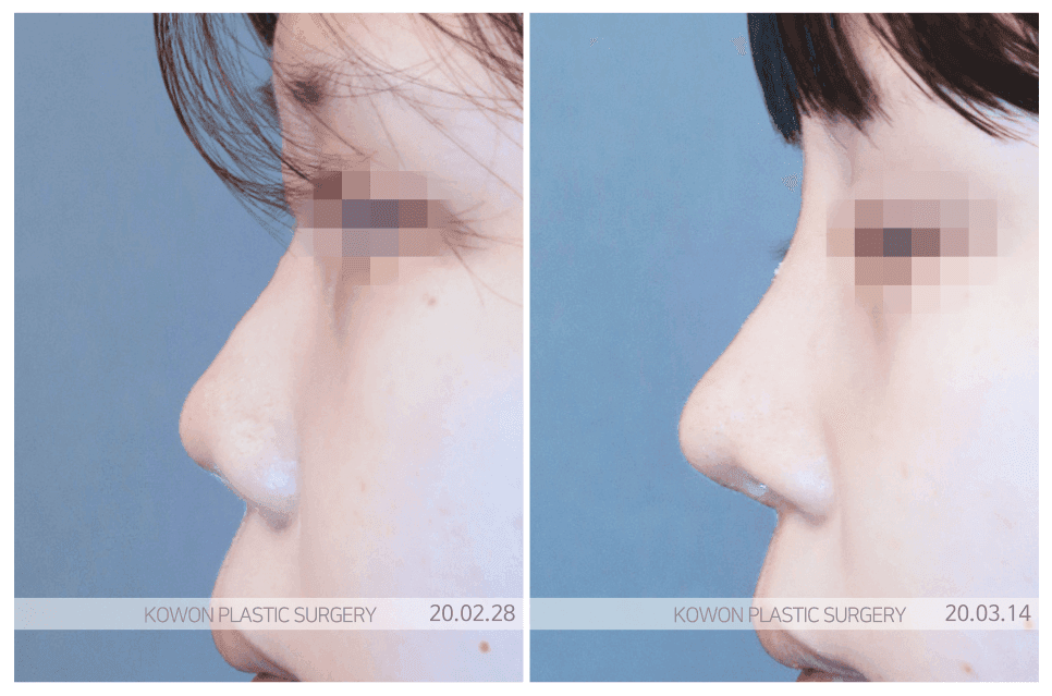 납작코, 보형물만 넣으면 해결될까 — 조화·안정성으로 보는 교정 기준 관련 이미지 4/4