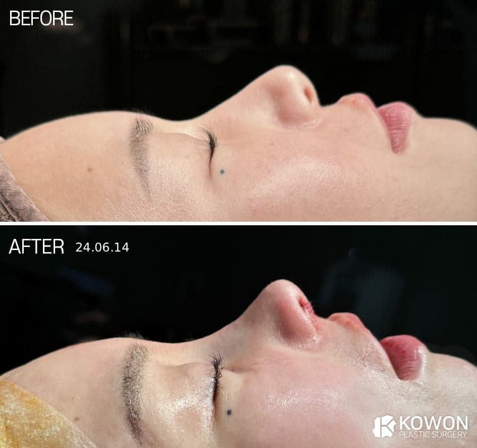 기능코성형, 보험보다 먼저 봐야 하는 것은 숨쉬는 구조입니다 관련 이미지 2/5