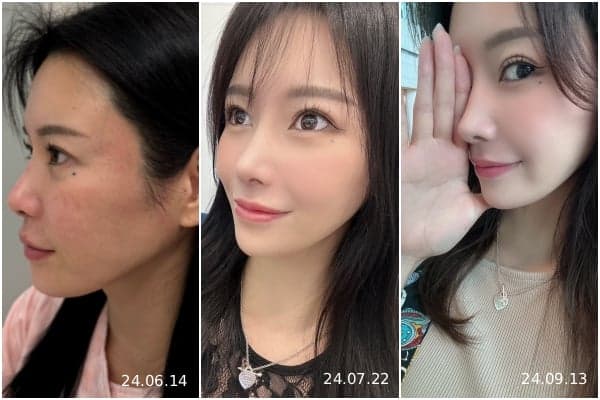 ศัลยกรรมจมูกเพื่อการหายใจสิ่งที่คุณควรพิจารณาก่อนทำประกันคือโครงสร้างการหายใจ ภาพที่เกี่ยวข้อง 5/5