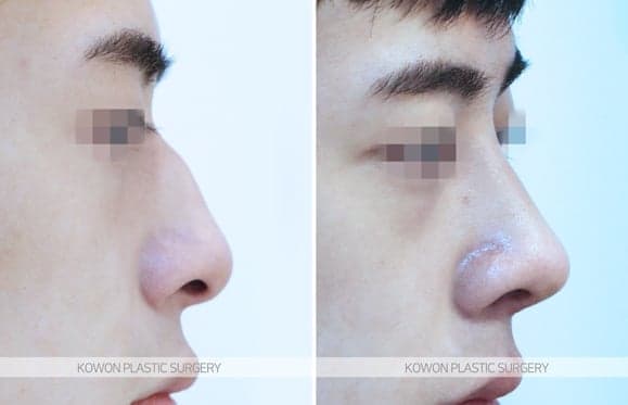 휘어진 코, 실비보험이 될까요 — 기능코성형에서 보험이 적용되는 경우와 아닌 경우 관련 이미지 3/5