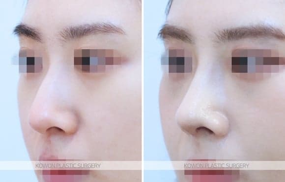 휘어진 코, 실비보험이 될까요 — 기능코성형에서 보험이 적용되는 경우와 아닌 경우 관련 이미지 4/5