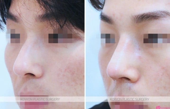 휘어진 코, 실비보험이 될까요 — 기능코성형에서 보험이 적용되는 경우와 아닌 경우 관련 이미지 5/5