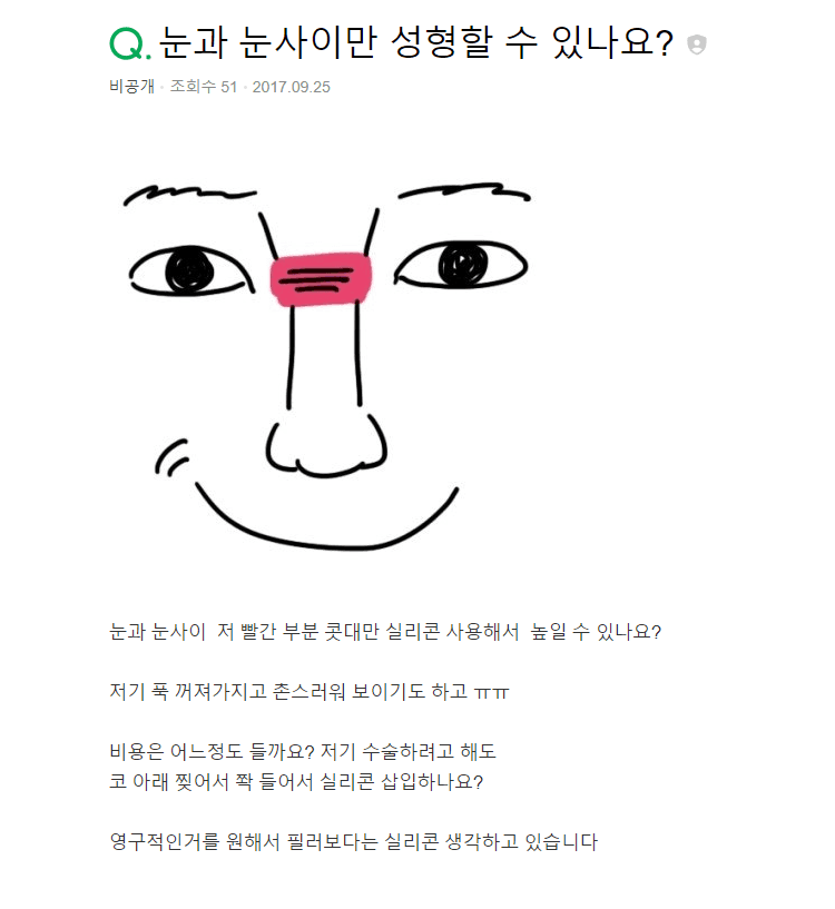 눈과 눈 사이 콧대만 낮다면 — 비개방 코성형으로 미간을 높이는 방법 관련 이미지 2/2