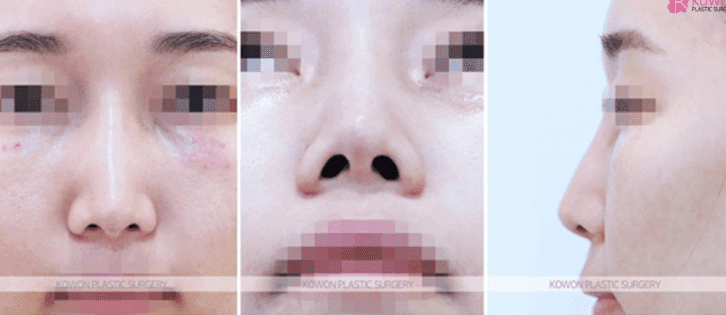 Image 5/10 for: glabella bridge revision — lowering the bridge