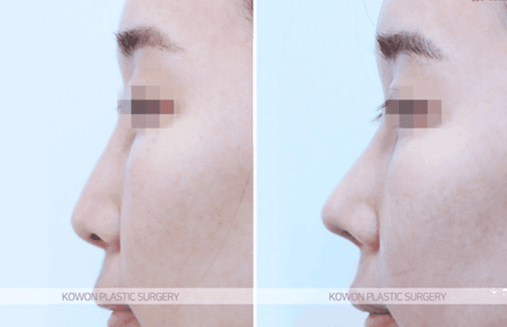 Image 7/10 for: glabella bridge revision — lowering the bridge