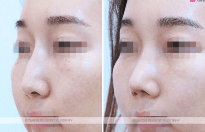 Image 8/10 for: glabella bridge revision — lowering the bridge