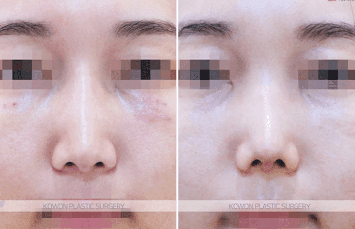 Image 10/10 for: glabella bridge revision — lowering the bridge