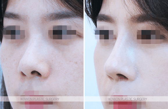 코수술 후 안경에 코가 눌렸어요 — 괜찮은 경우와 병원에 가야 하는 증상 구분 관련 이미지 4/5