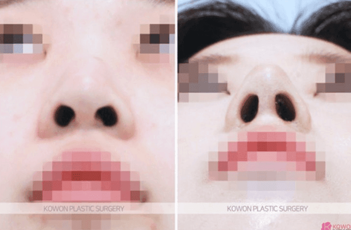 코수술 후 안경에 코가 눌렸어요 — 괜찮은 경우와 병원에 가야 하는 증상 구분 관련 이미지 5/5