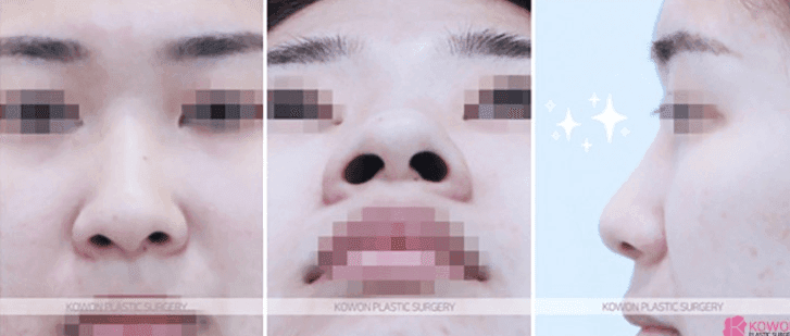 코수술 6개월 후 안경을 쓰면 통증이 있다면 — 염증 가능성과 내원이 필요한 이유 관련 이미지 3/10