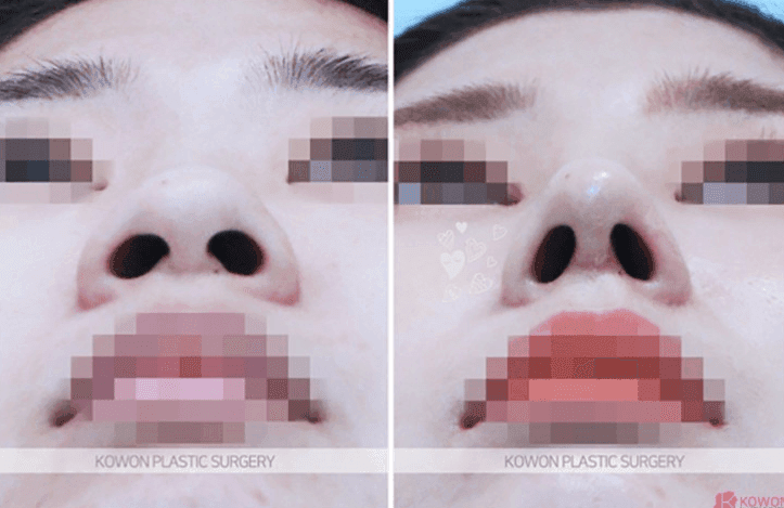 코수술 6개월 후 안경을 쓰면 통증이 있다면 — 염증 가능성과 내원이 필요한 이유 관련 이미지 5/10
