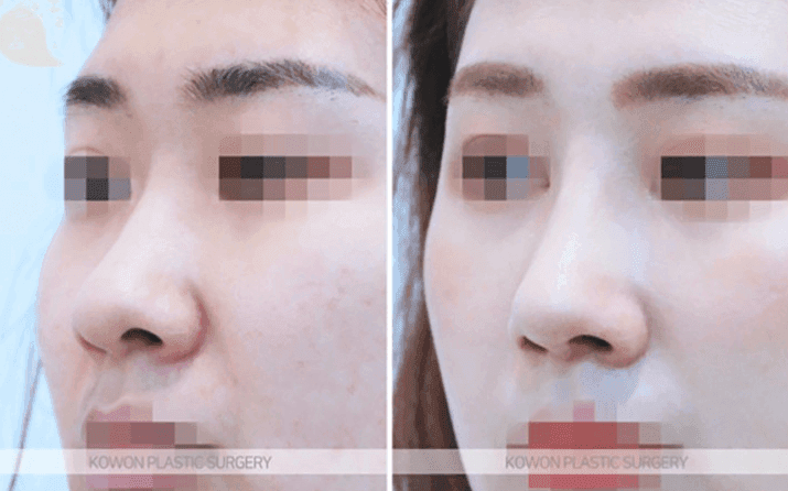 코수술 6개월 후 안경을 쓰면 통증이 있다면 — 염증 가능성과 내원이 필요한 이유 관련 이미지 6/10