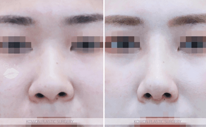 코수술 6개월 후 안경을 쓰면 통증이 있다면 — 염증 가능성과 내원이 필요한 이유 관련 이미지 7/10