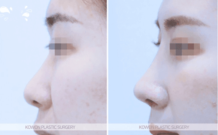 หากคุณมีอาการปวดขณะสวมแว่นตา 6 เดือนหลังการผ่าตัดจมูก— อาจเกิดจากการอักเสบและเหตุใดจึงจำเป็นต้องไปพบแพทย์ ภาพประกอบ 8/10