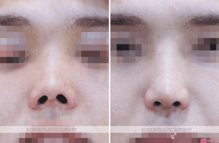 고어텍스 보형물, 5년 지나면 바꿔야 하나요 — 코성형 유지기간과 염증 걱정 정리 관련 이미지 4/5