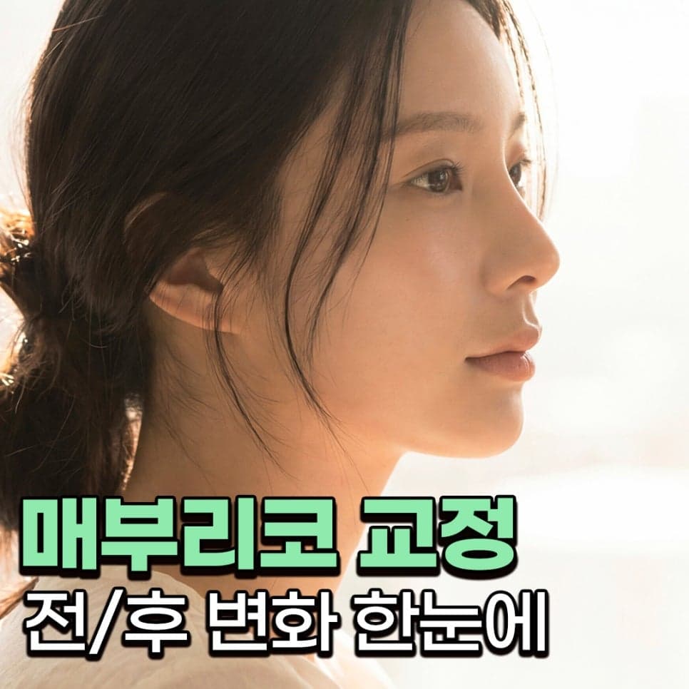 매부리코성형, 복코·넓은 콧볼이 함께라면 — 콧대부터 비주까지 균형을 본 사례 관련 이미지 1/8