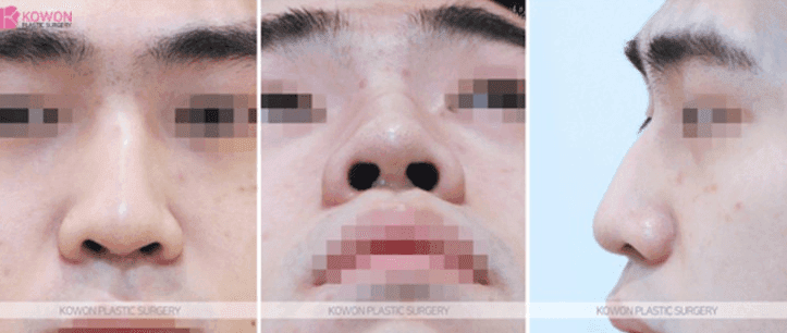 매부리코 성형·코골절수술 후에도 콧대가 높다면 — 더 깎을 수 있는지, 재수술로 무엇이 가능한지 관련 이미지 4/9