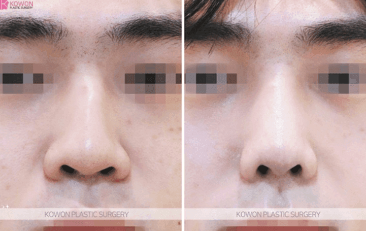 หากสันจมูกยังคงสูงอยู่แม้หลังจากแก้ไขจมูกโหนกและศัลยกรรมตกแต่งจมูกแล้ว สามารถตัดแต่งเพิ่มเติมได้หรือไม่ และอะไรบ้างที่สามารถทำได้ในการผ่าตัดแก้ไขเพิ่มเติม (ภาพที่ 6/9)