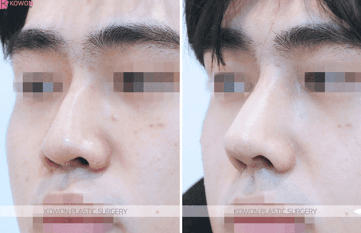 매부리코 성형·코골절수술 후에도 콧대가 높다면 — 더 깎을 수 있는지, 재수술로 무엇이 가능한지 관련 이미지 7/9