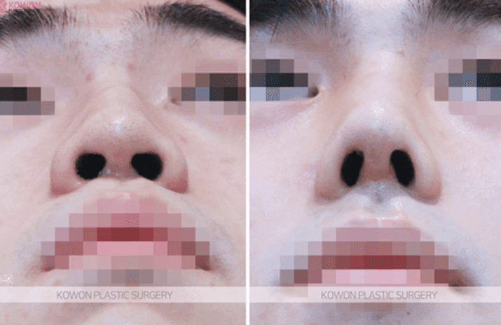 매부리코 성형·코골절수술 후에도 콧대가 높다면 — 더 깎을 수 있는지, 재수술로 무엇이 가능한지 관련 이미지 8/9