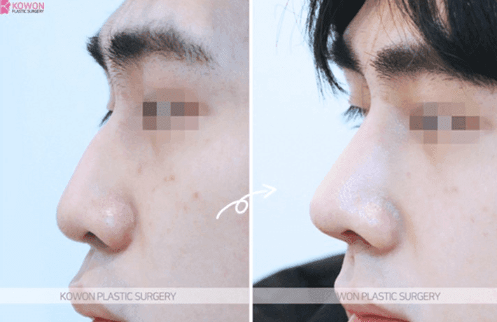 매부리코 성형·코골절수술 후에도 콧대가 높다면 — 더 깎을 수 있는지, 재수술로 무엇이 가능한지 관련 이미지 9/9