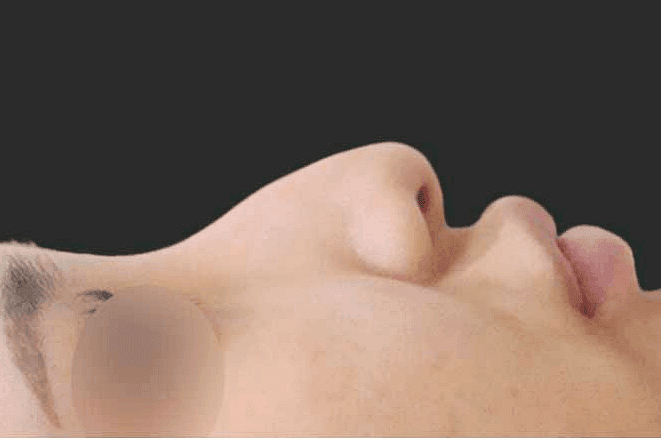매부리코 교정, 비용보다 먼저 확인할 것 — 깎는 범위·연골 선택·지지 구조 관련 이미지 2/5