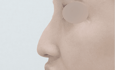 매부리코 교정, 비용보다 먼저 확인할 것 — 깎는 범위·연골 선택·지지 구조 관련 이미지 4/5